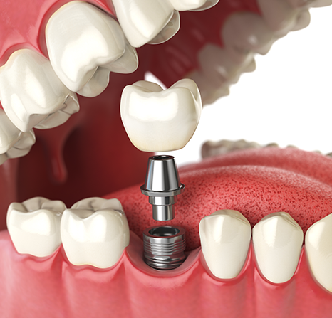 A 3D illustration of an implant being placed.